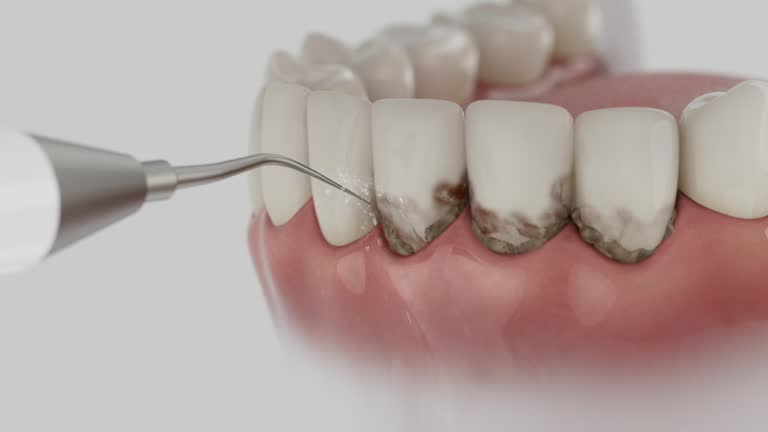 Trusted Wisdom Tooth Removal service in West Hattiesburg, MS - Dentist Open Now